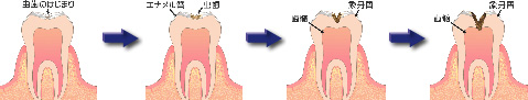 虫歯治療